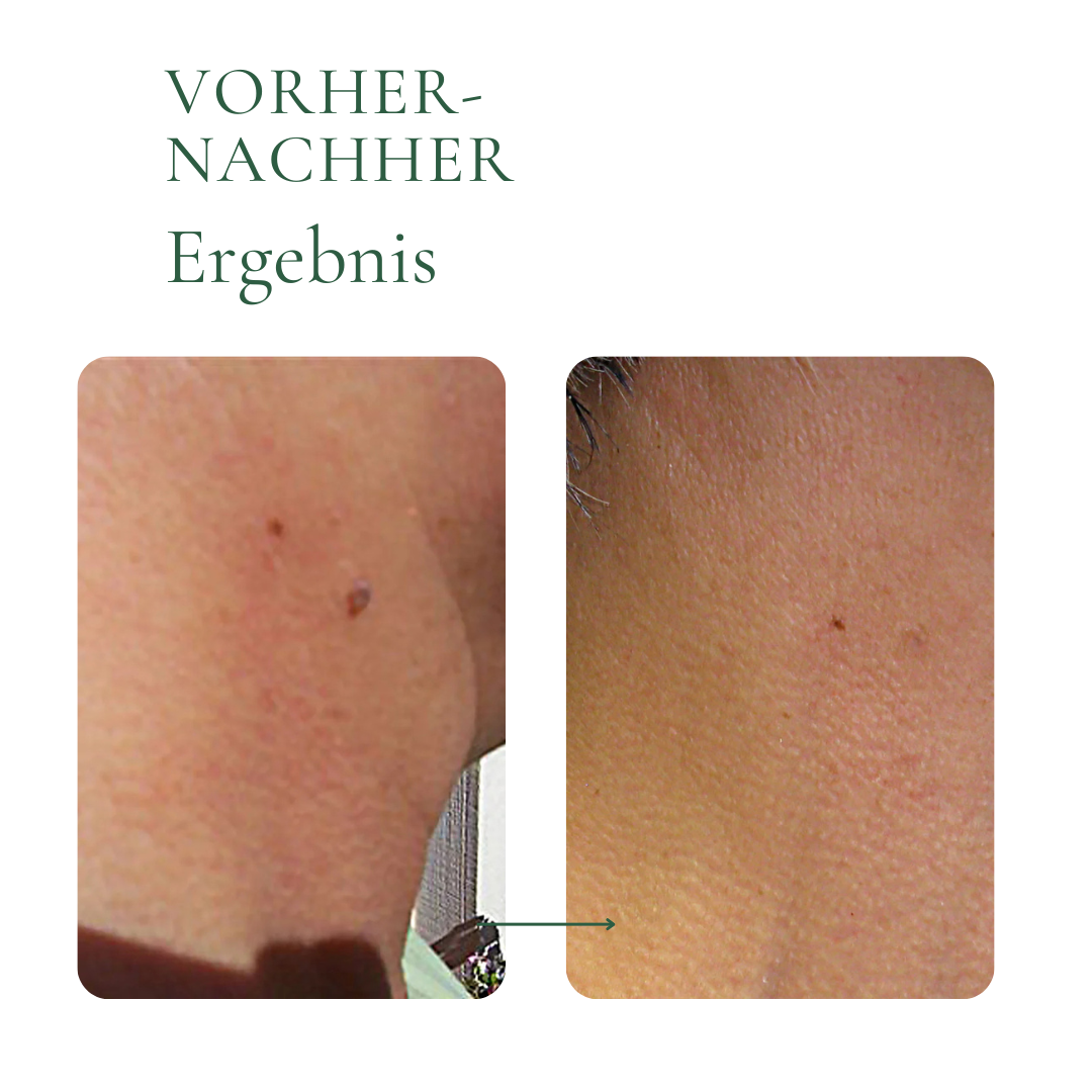 Creamole - 100% natürliche Creme zur Entfernung von Muttermalen, Leberflecken & Warzen