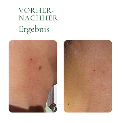 Creamole - 100% natürliche Creme zur Entfernung von Muttermalen, Leberflecken & Warzen