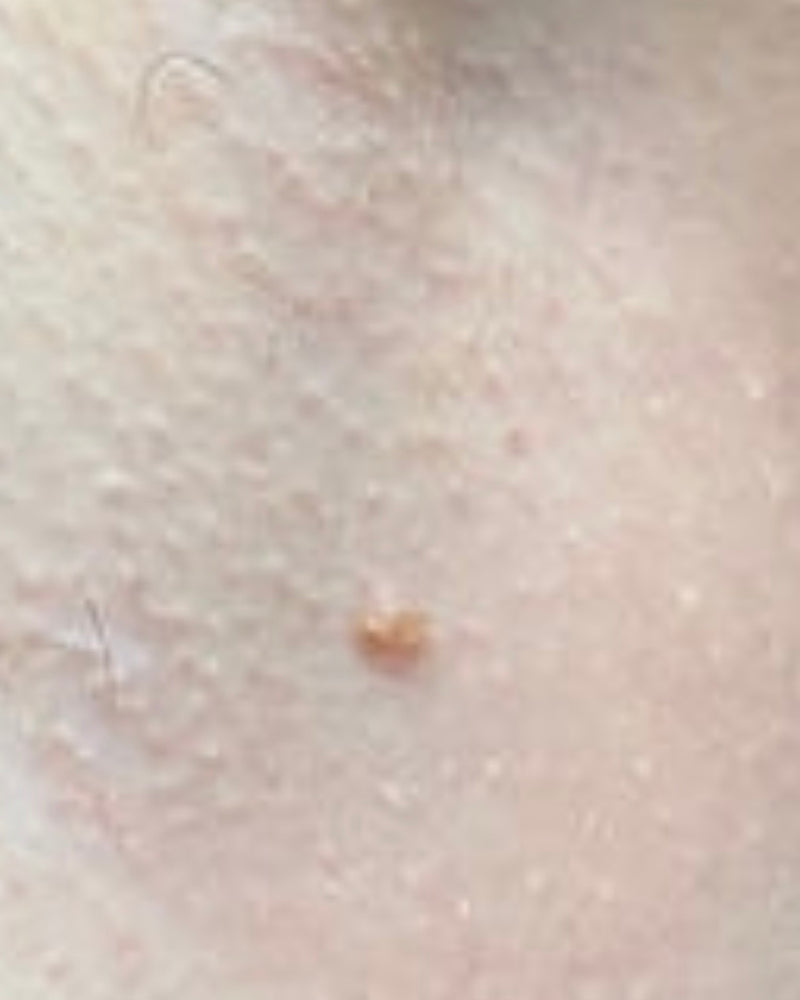 Vorher – Hals/Dekolleté