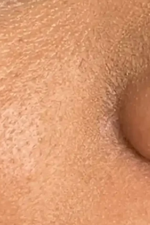 Nachher – neben der Nase